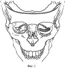 Способ восстановления нижней стенки глазницы и нижнеглазничного края после травмы (патент 2486872)