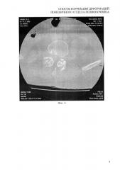 Способ коррекции деформаций поясничного отдела позвоночника (патент 2621170)