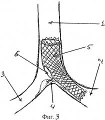 Способ стентирования бифуркации трахеи (патент 2465850)
