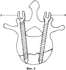 Способ репозиции и фиксации позвоночника при оскольчатых переломах (патент 2436534)