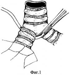 Способ обработки культи главного бронха (патент 2271155)