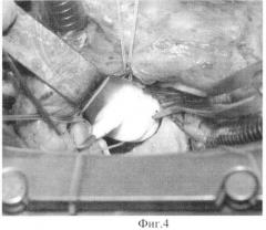 Способ имплантации механического протеза клапана сердца (патент 2454204)