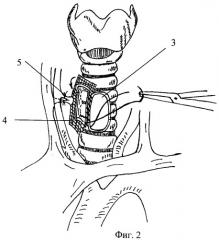 Способ замещения окончатых дефектов трахеи и гортани (патент 2440789)