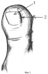 Способ комплексного лечения вросшего ногтя (патент 2448657)