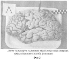 Способ фиксации головного мозга человека без вскрытия полости черепа (патент 2360612)