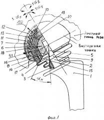 Биартикулярный жидкостно-циркуляционный анатомически адаптируемый эндопротез тазобедренного сустава (патент 2662710)