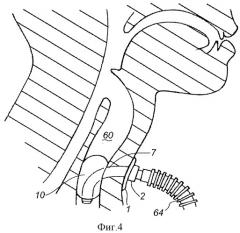 Аспирационная система, расположенная ниже голосовой щели (патент 2537944)