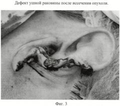 Способ пластики завитка и мочки ушной раковины (патент 2445006)
