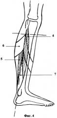 Способ ампутации нижней конечности на уровне голени (патент 2354312)