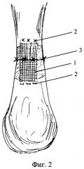 Способ пластики поврежденных связок и сухожилий (патент 2303411)