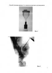 Способ лечения артроза 1-го запястно-пястного сустава кисти (патент 2662896)