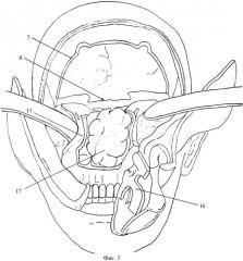 Способ доступа при операциях по поводу опухолей полости носа и центральной части основания черепа (патент 2408293)