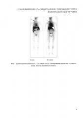 Способ выявления очагов воспаления с помощью методики полиорганной сцинтиграфии (патент 2648877)