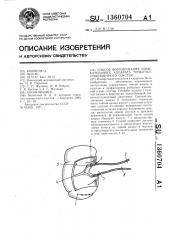 Способ формирования замыкательного аппарата тонкотолстокишечного соустья (патент 1360704)