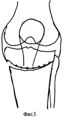 Способ лечения гонартроза, сопровождающегося осевыми деформациями нижней конечности (патент 2545917)