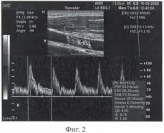 Способ измерения скорости винтового движения крови в артериях (патент 2380040)