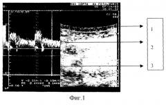 Способ диагностики и прогнозирования резервов кровообращения глазного яблока при ишемических оптикопатиях зрительного нерва у лиц геронтологического возраста (патент 2261659)
