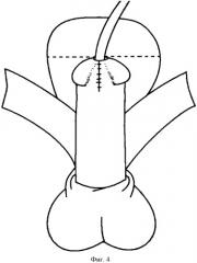 Способ хирургического лечения гипоспадии у мальчиков (патент 2435527)