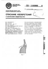 Способ хирургического устранения дополнительного предсердно- желудочкового проведения по ю.ю.бредикису (патент 1183080)