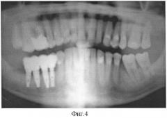 Дентальный внутрикостный имплантат (патент 2376955)
