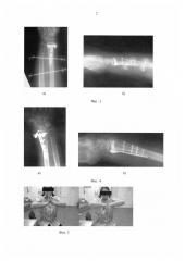 Способ открытой репозиции и остеосинтеза переломов дистального отдела лучевой кости (патент 2601850)