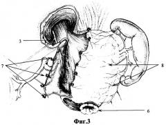 Способ хирургического лечения пептических язв гастроэнтероанастомоза после резекции желудка по бильрот-ii (патент 2278620)