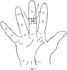 Способ оперативного лечения рубцовой сгибательной контрактуры пальцев кисти легкой степени после ожога (патент 2267301)