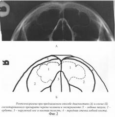 Способ рентгенографии лобных пазух (патент 2253367)