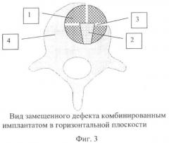 Способ переднего комбинированного спондилодеза при воспалительных заболеваниях позвоночника (патент 2364362)