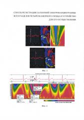 Способ регистрации латентной электрокардиограммы всех разделов четырехкамерного сердца и устройство для его осуществления (патент 2633347)