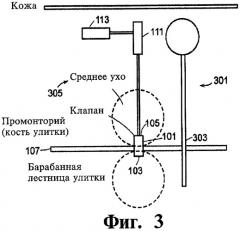 Имплантируемое устройство и способ доставки текучего лекарственного препарата в ткань (патент 2423154)