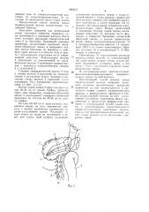 Способ лечения свища поджелудочной железы (патент 1066571)