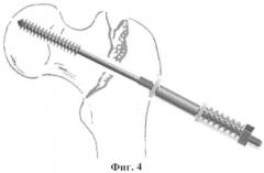Устройство для остеосинтеза (патент 2345731)