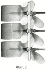 Способ лечения оскольчатого перелома тела позвонка со сдавлением дурального мешка (патент 2433797)
