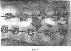 Способ ортодонтического лечения детей с ретенированными зубами (патент 2629061)