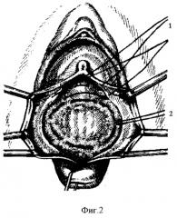 Способ хирургической реконструкции пузырно-влагалищной перегородки при опущении и выпадении передней стенки влагалища и цистоцеле (патент 2262314)