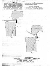 Способ оперативного лечения сгибательных контрактур коленного сустава (патент 719619)