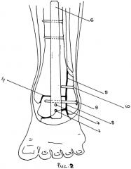Способ артродеза суставов заднего отдела стопы (патент 2549296)