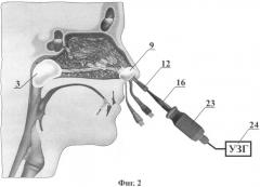 Устройство для озон/no-ультразвуковой терапии экссудативных синуситов (патент 2412683)