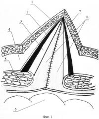 Способ герниопластики при послеоперационных вентральных грыжах (патент 2546927)