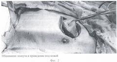 Способ пластики щеки пекторальным лоскутом с двойной кожной площадкой (патент 2380053)