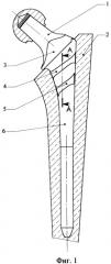 Ножка эндопротеза тазобедренного сустава (патент 2262912)