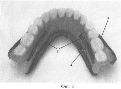 Способ изготовления полных съемных зубных протезов (патент 2448665)
