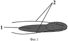 Способ и устройство для реконструкции нижней стенки орбиты и устранения энофтальма (патент 2530752)