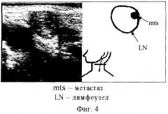 Способ ультразвуковой диагностики метастатического поражения регионарных лимфатических узлов (патент 2284754)