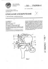 Дистракционный аппарат для формирования крыши вертлужной впадины (патент 1762908)