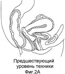 Коррекция стрессового недержания мочи (патент 2548825)