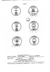 Способ удаления цилиохориоидальных опухолей (патент 1442213)