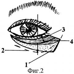 Способ нижней блефаропластики (патент 2254109)
