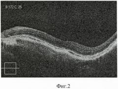 Способ ранней доклинической диагностики прогрессирования эпиретинальной мембраны у пациентов с высокой миопией (патент 2407444)